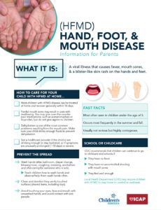 Hand, Foot, and Mouth Disease May 24, 2024